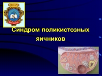 Синдром поликистозных яичников