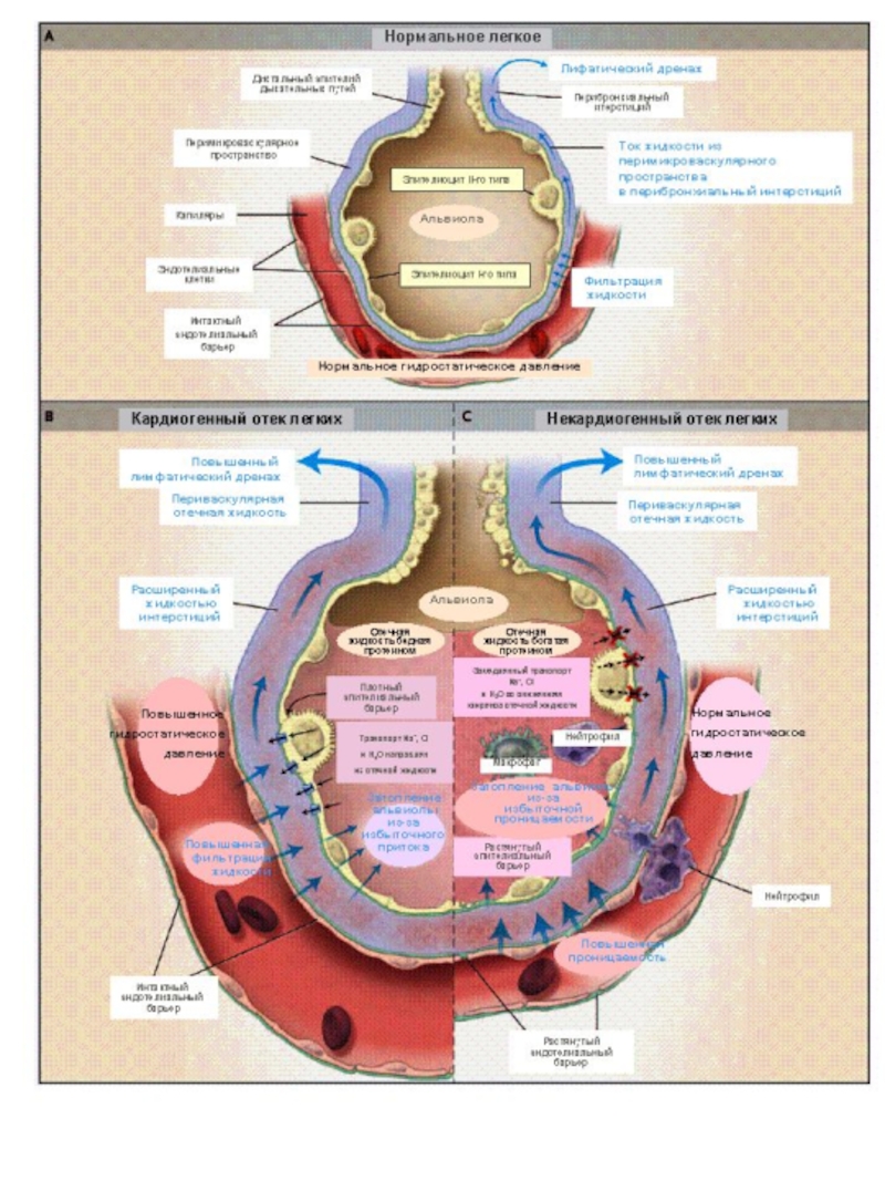 Кардиогенный отек. Кардиогенный отек легких патогенез. Кардиогенный отек легких механизм развития. Патогенез кардиогенного отёка лёгких. Схема развития отека легких.