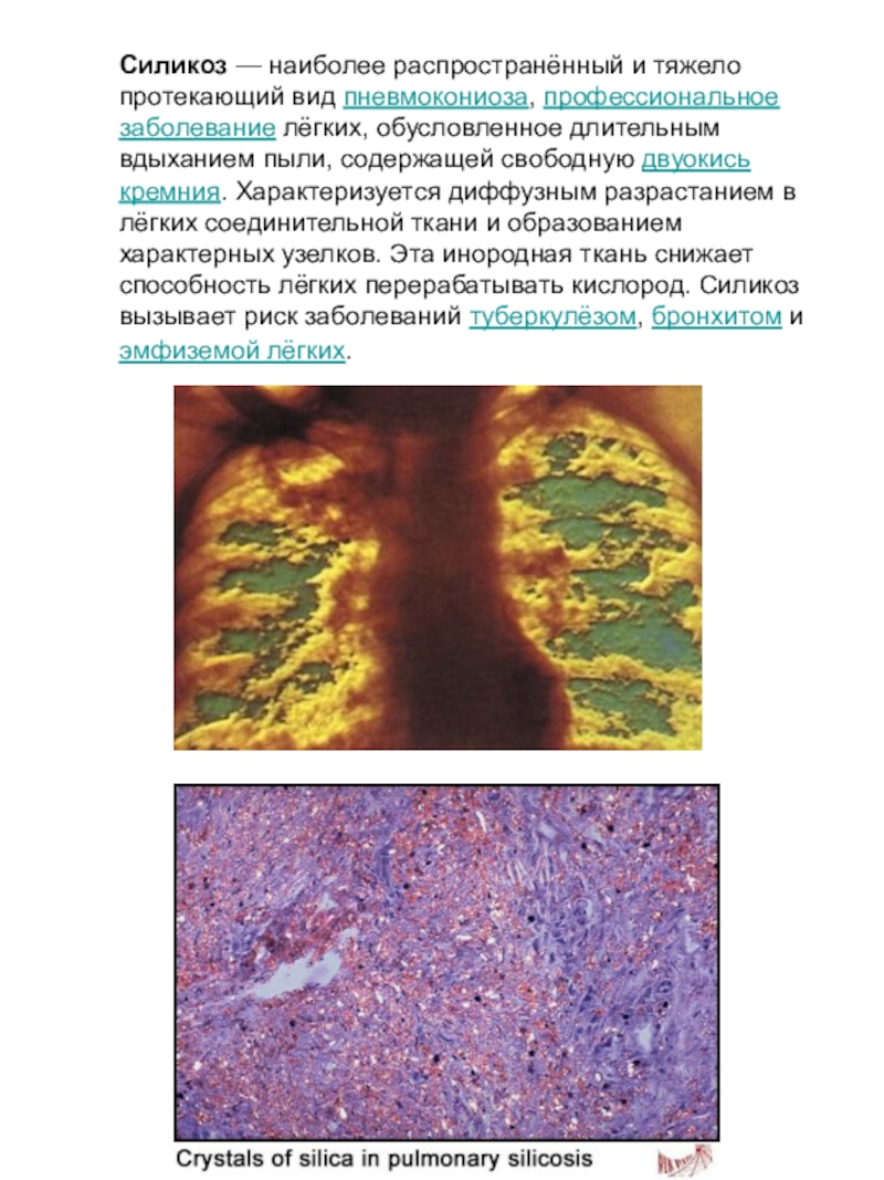 Силикоз. Силикозы профессиональные болезни. Болезнь лёгких силикоз. Сидероз профессиональные болезни.