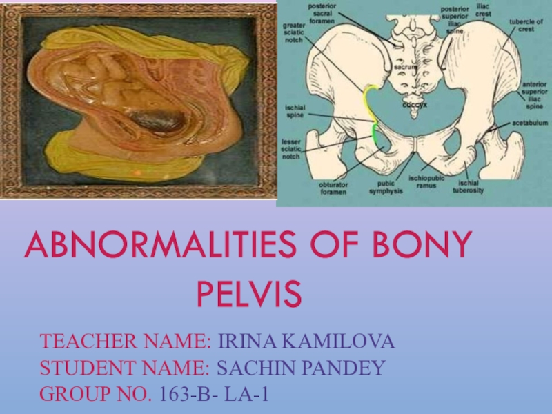ABNORMALITIES OF BONY PELVIS