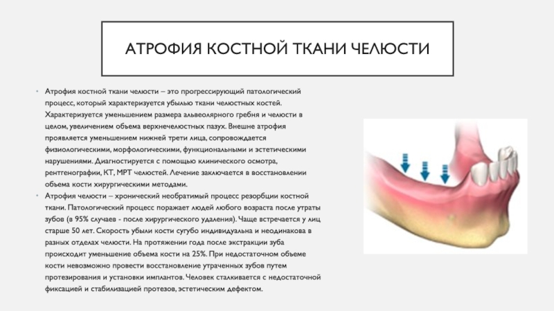 Атрофия альвеолярного отростка нижней челюсти