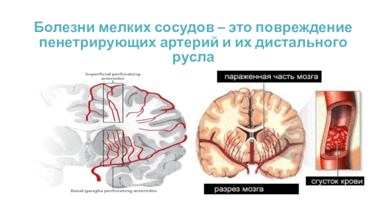 Дисциркуляторного характера мозга. Пенетрирующие артерии. Пенетрирующие мозговые артерии. Болезнь мелких артерий. Пенетрирующие артерии головного мозга.