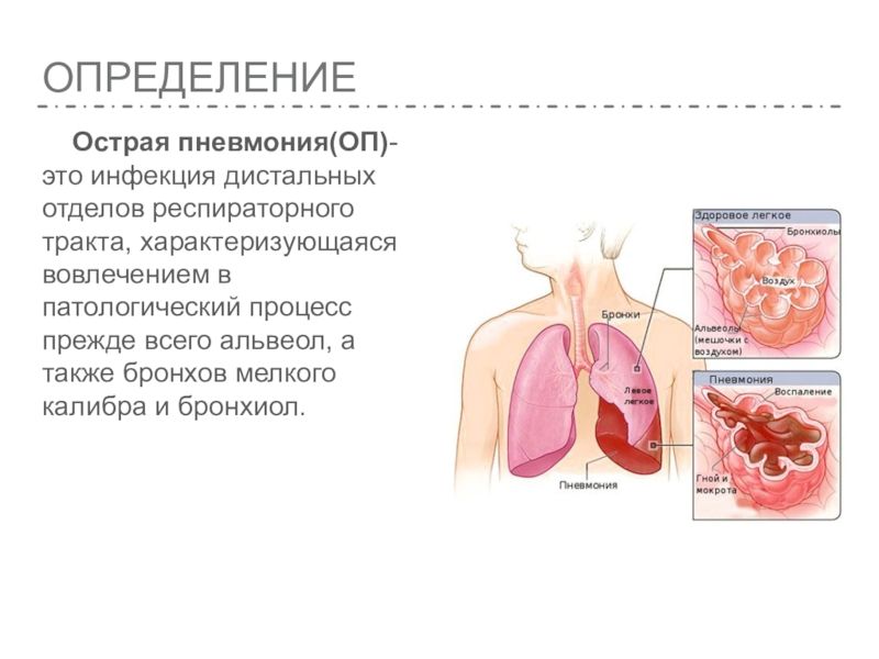 Острая пневмония