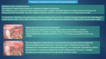 Техника лапароскопической аднексэктомии
Базовые этапы лапараскопии :
Наложение