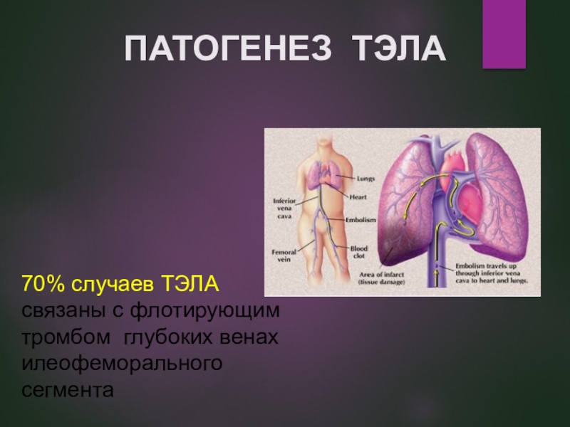 Источники тромбоэмболии легочной артерии. Тромбоэмболия легочной артерии патогенез.