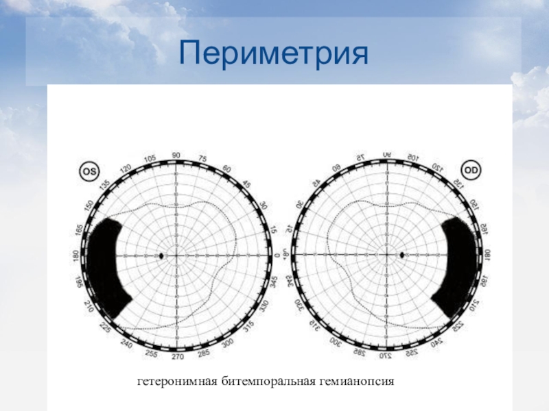 Кинетическая периметрия. Периметрия. Компьютерная периметрия. Периметрия гемианопсия. Гетеронимная битемпоральная гемианопсия.