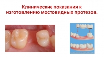 Клинические показания к изготовлению мостовидных протезов