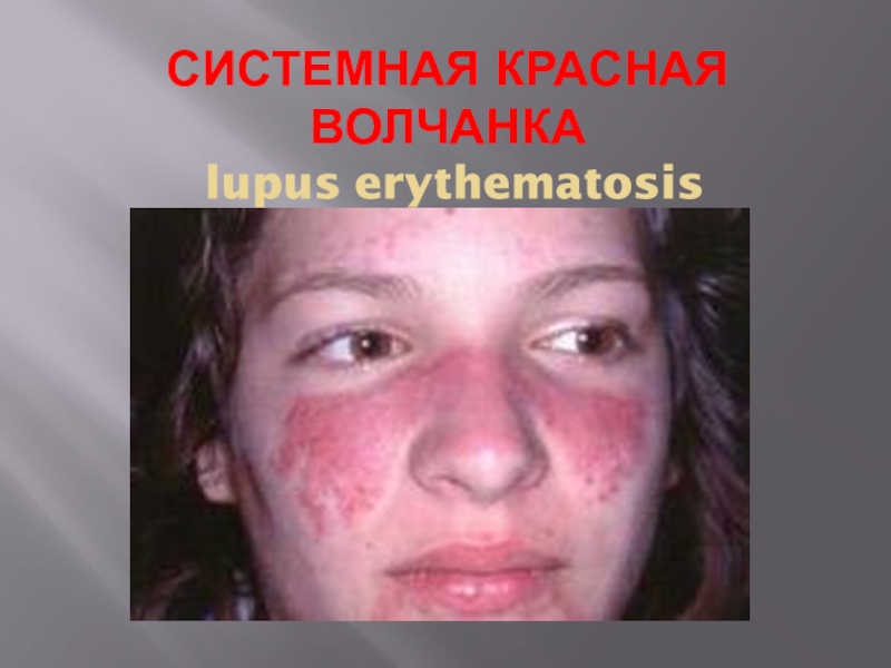 СИСТЕМНАЯ КРАСНАЯ ВОЛЧАНКА lupus erythematosis