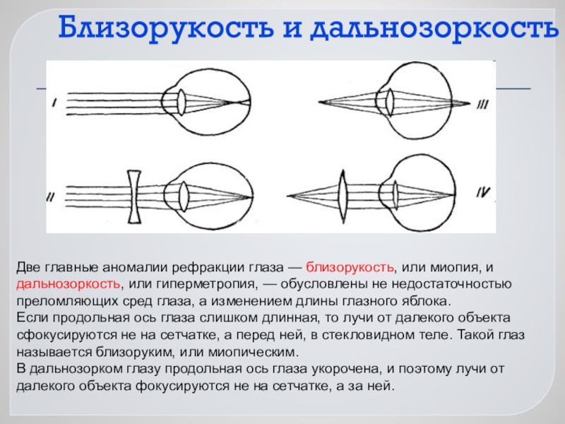 Близорукость схема глаза