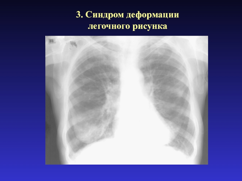 Патология легочного рисунка