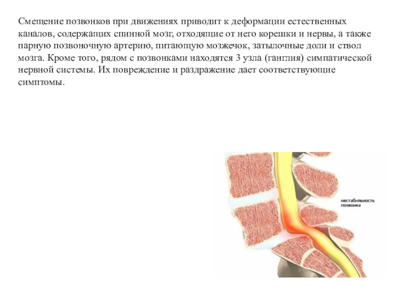 Нестабильность позвоночника. Нестабильность шейного отдела позвоночника. Нестабильный шейный позвонок. Нестабильность позвонков шейного отдела. Нестабильный позвонок шейного отдела.