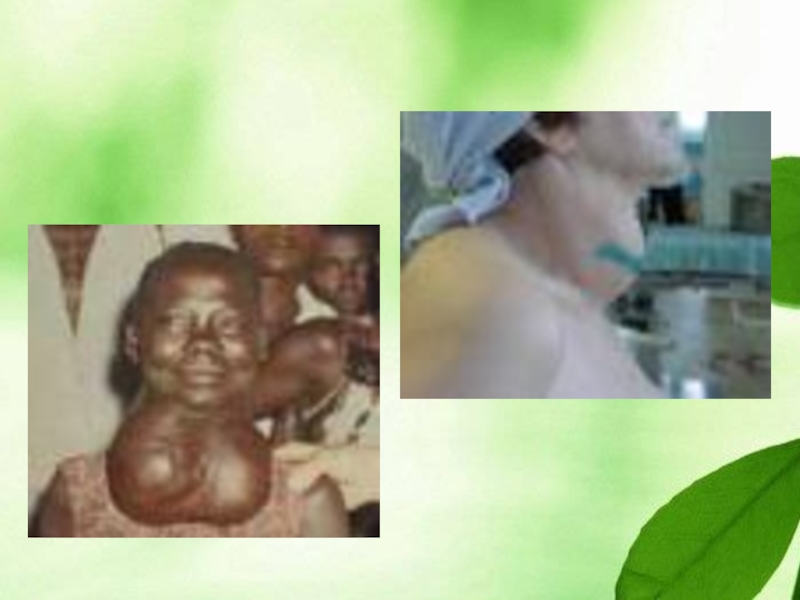 Железы внутренней секреции Зоб Зоб