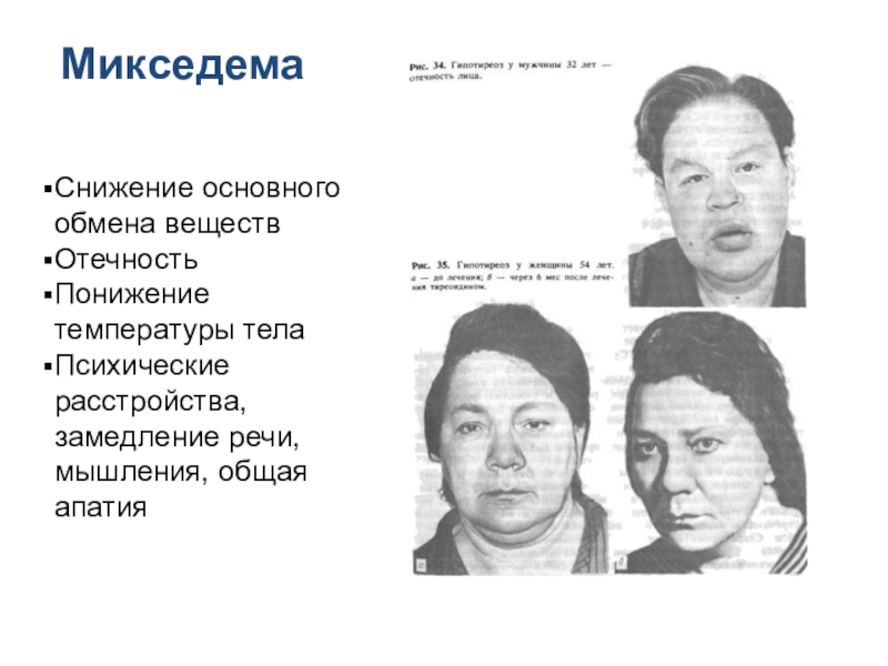 Железы внутренней секреции МикседемаСнижение основного обмена веществОтечностьПонижение температуры телаПсихические расстройства, замедление речи, мышления, общая апатия МикседемаСнижение основного обмена веществОтечностьПонижение температуры телаПсихические расстройства, замедление речи, мышления, общая апатия