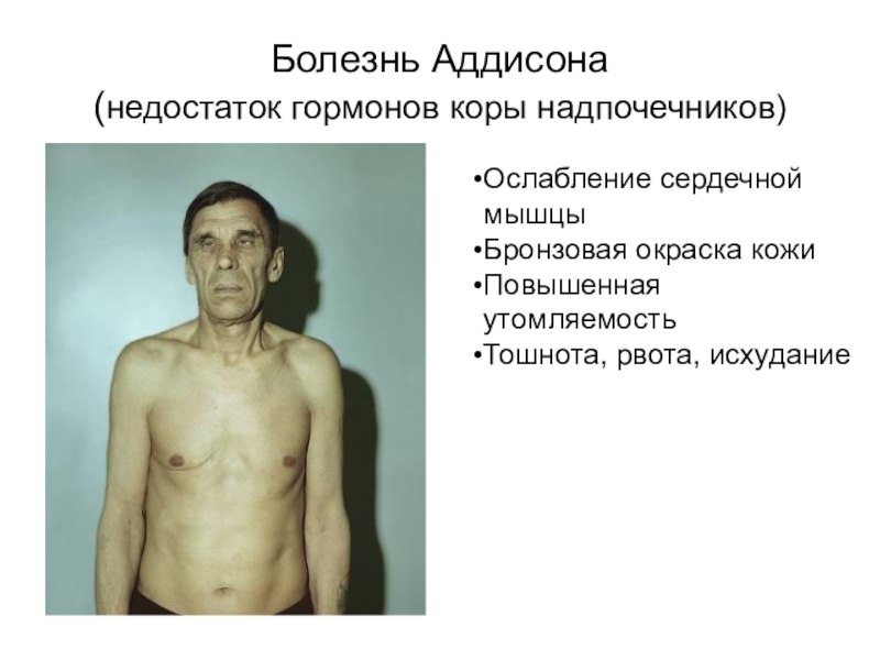 Железы внутренней секреции Болезнь Аддисона (недостаток гормонов коры надпочечников)Бронзовая окраска кожиОслабление сердечной мышцыПовышенная утомляемостьТошнота, Болезнь Аддисона (недостаток гормонов коры надпочечников)Бронзовая окраска кожиОслабление сердечной мышцыПовышенная утомляемостьТошнота, рвота, исхуданиеОслабление сердечной мышцыБронзовая окраска кожиПовышенная
