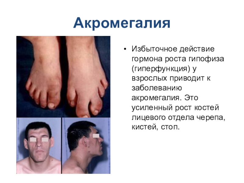 Железы внутренней секреции АкромегалияИзбыточное действие гормона роста гипофиза(гиперфункция) у взрослых приводит к заболеванию акромегалия. АкромегалияИзбыточное действие гормона роста гипофиза(гиперфункция) у взрослых приводит к заболеванию акромегалия. Это усиленный рост костей лицевого отдела