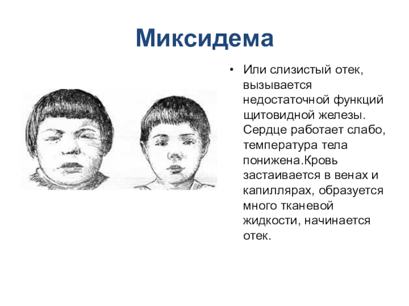 Железы внутренней секреции МиксидемаИли слизистый отек, вызывается недостаточной функций щитовидной железы. Сердце работает слабо, МиксидемаИли слизистый отек, вызывается недостаточной функций щитовидной железы. Сердце работает слабо, температура тела понижена.Кровь застаивается в венах