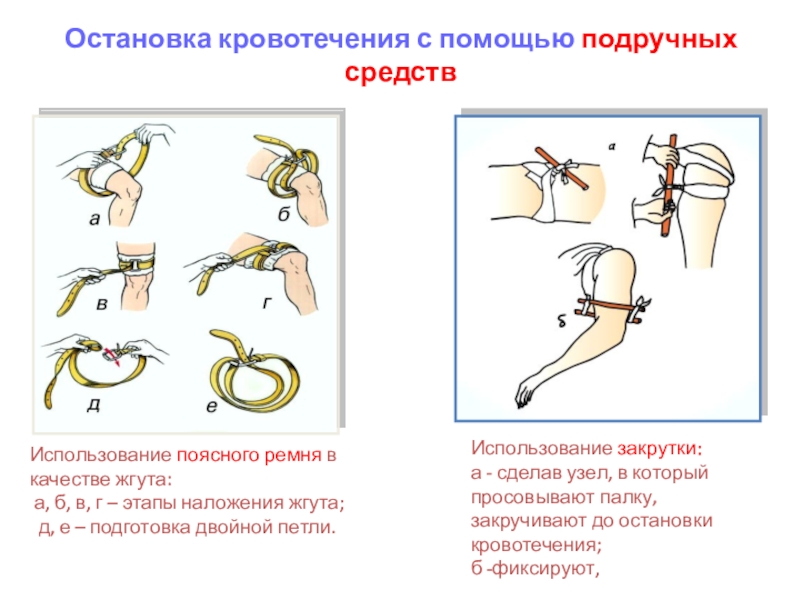 Наложение венозных жгутов. Наложение жгута Альфа алгоритм. Наложение жгута для остановки кровотечения. Жгут Альфа кровоостанавливающий наложение. Использование поясного ремня в качестве кровоостанавливающего жгута.