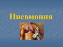 Пневмония