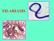 FILARIASIS