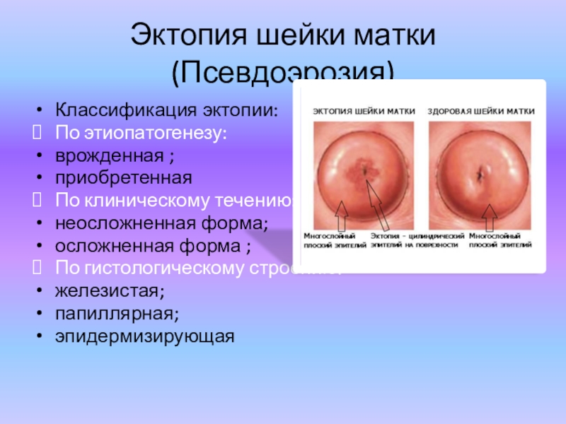 Эктопия шейки матки (Псевдоэрозия)