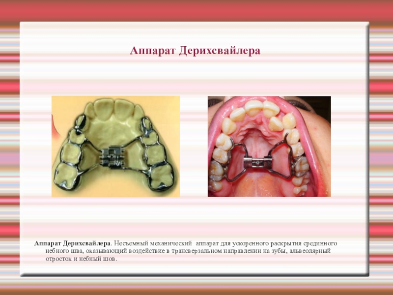 Ортодонтические аппараты механического действия презентация