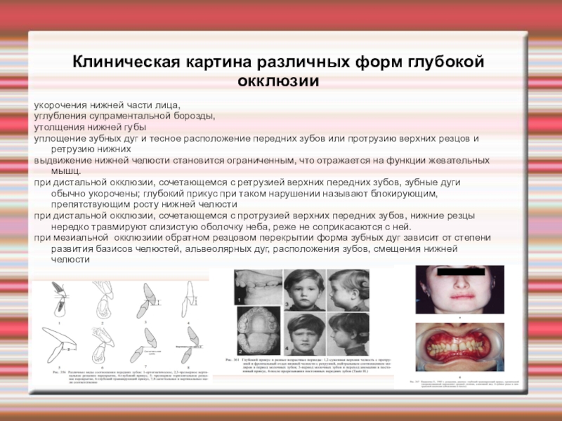 Этиология классификация клиническая картина диагностика и лечение различных форм дистальной окклюзии