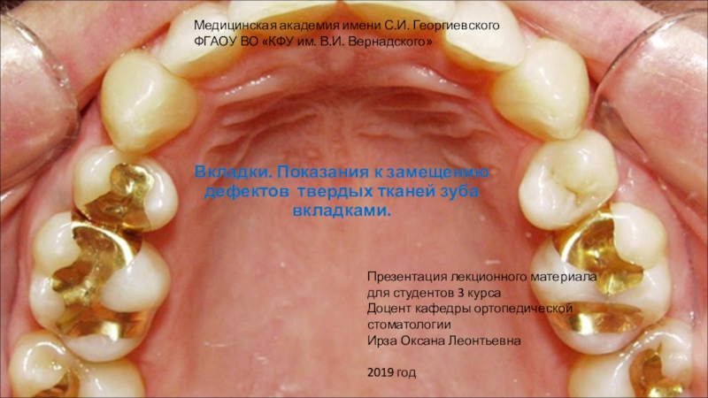 Вкладки. Показания к замещению дефектов твердых тканей зуба вкладками