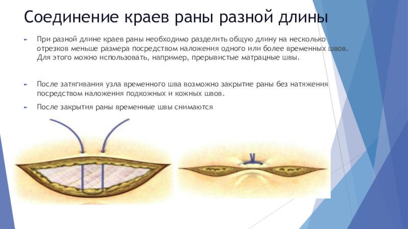 Швами соединены. Сведение вместе краев раны. Чем соединить края раны. Линия соединения краев раны.