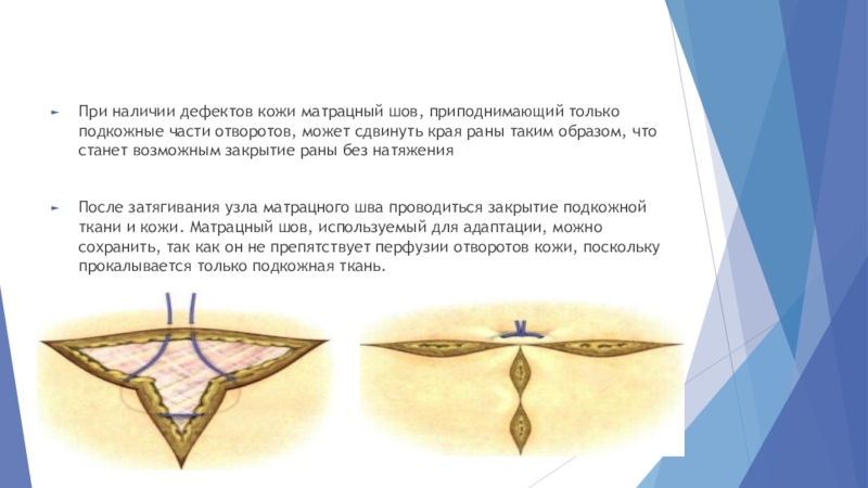 Краев ран. Варианты закрытия дефектов кожи. Закрытие круглого дефекта кожи. Схемы закрытия дефектов кожи. Адаптационный шов кожи.