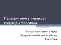 Перекрут яичка, перекрут гидатиды Морганьи