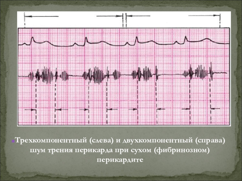 Шум трения перикарда. Шум при фибринозном перикардите. Фибринозный перикардит шум трения перикарда. Шум трения перикарда при фибринозном перикардите. Фибринозный перикардит аускультация.
