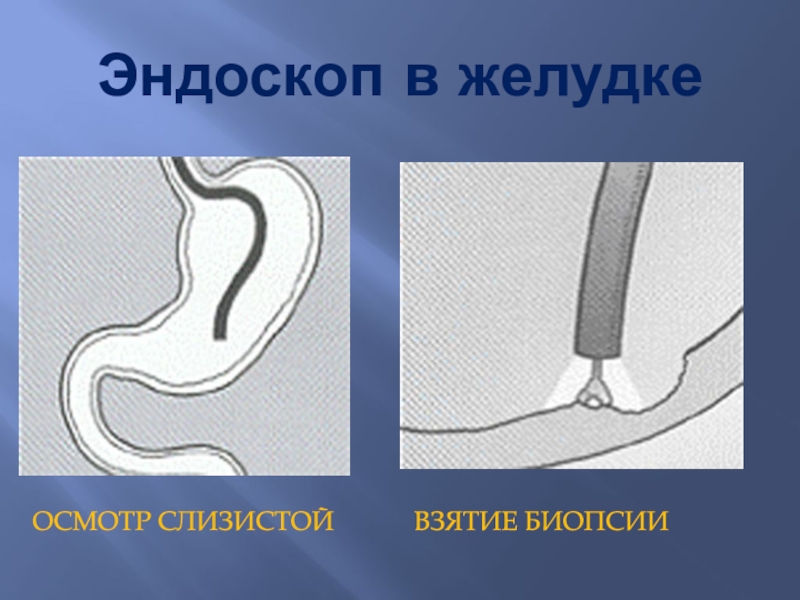 Взятие биопсии желудка