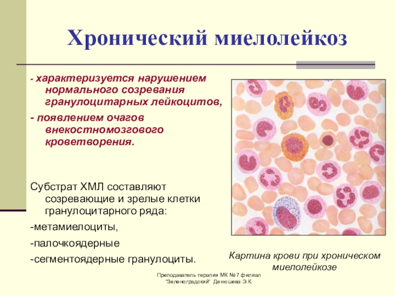 Хронический миелолейкоз- характеризуется нарушением нормального созревания гранулоцитарных лейкоцитов,- появлением очагов внекостномозгового кроветворения. Субстрат ХМЛ составляют созревающие и