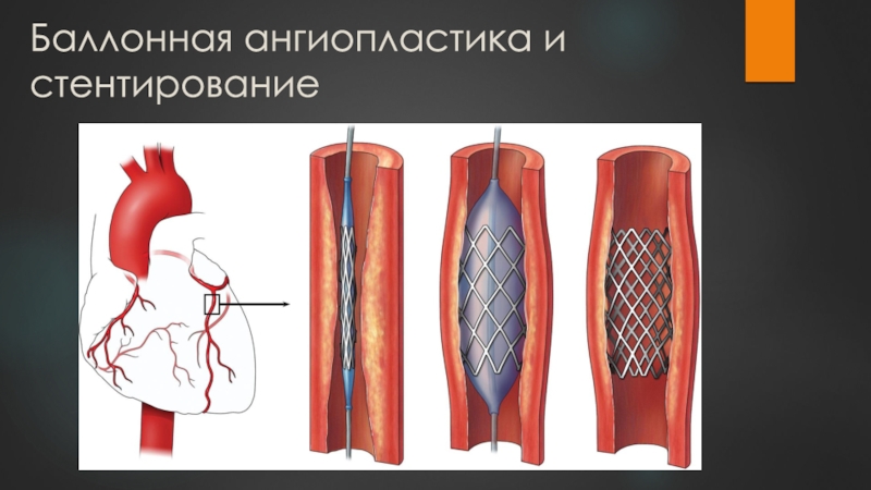 Аорта створки аортального клапана уплотнены. Баллонная ангиопластика и стентирование. Утолщение стенок аорты. Лазерная ангиопластика. Уплотнение стенок аорты что это такое.