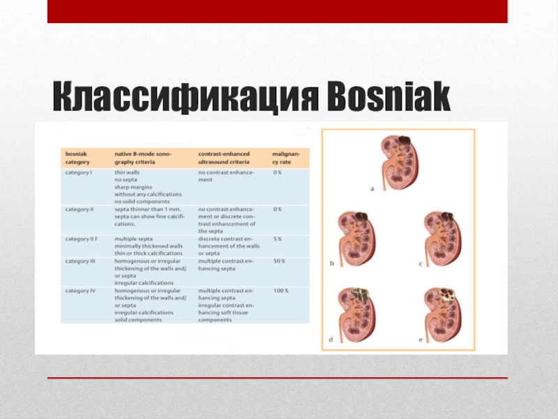 Кисты почек по босняк. Босниак классификация. Классификация по Bosniak. Классификация Bosniak 2019. Классификация Босниак УЗИ.