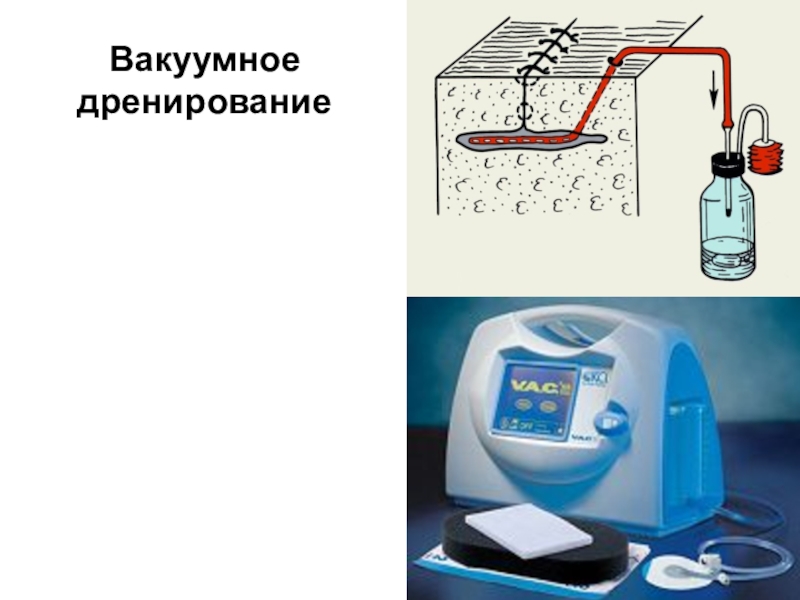 Дренирование ран презентация