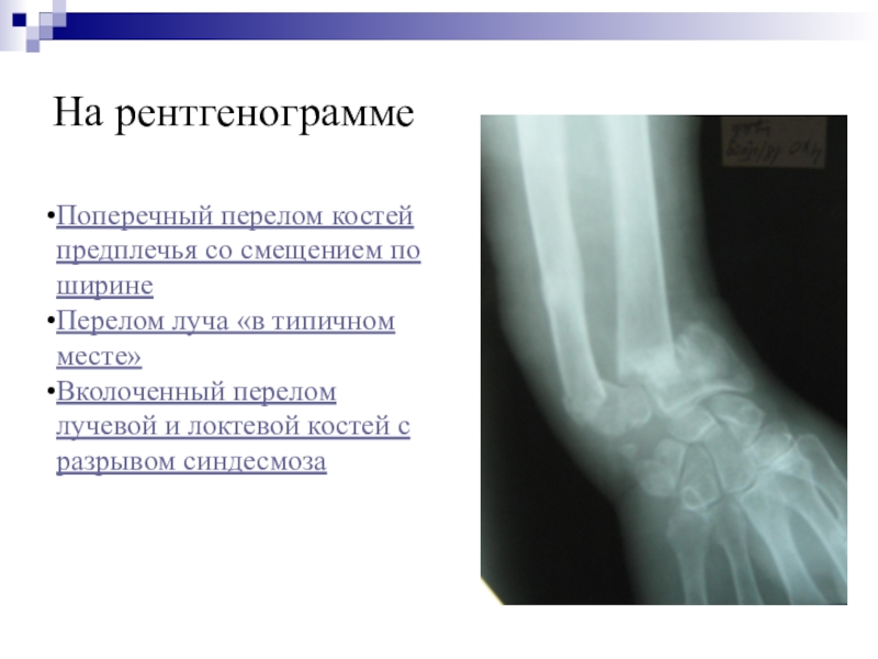 Перелом лучевой кости в типичном месте карта вызова смп