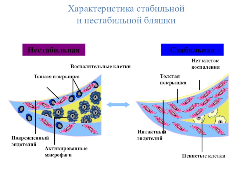 Стабильная и нестабильная бляшка. Интактный эндотелий это. Клетки эндотелия. Интактные эндотелиальные клетки. Воспалительные клетки.