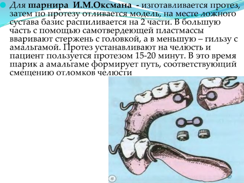 Для фиксации шарнира по оксману в протезах при ложных суставах применяется