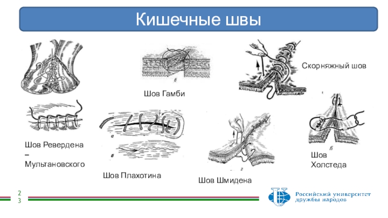 Шов мультановского схема