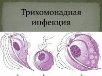 Трихомонадная инфекция