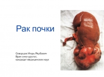 Рак почки