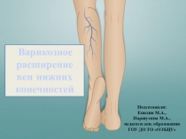 Варикозное расширение вен нижних конечностей
Подготовили:
Епихин