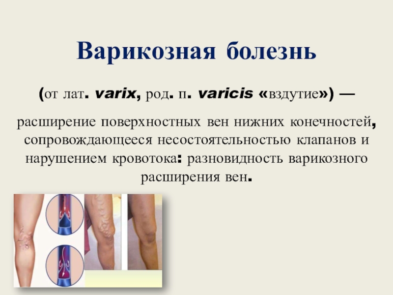 Доклад: Гимнастика от варикоза