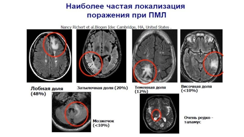 МР картина демиелинизирующего процесса в веществе головного мозга. Демиелинизирующее заболевание ЦНС. Мрт спинного мозга при демиелинизирующем процессе. Мрт картина демиелинизирующих заболеваний. Признаки демиелинизирующего поражения