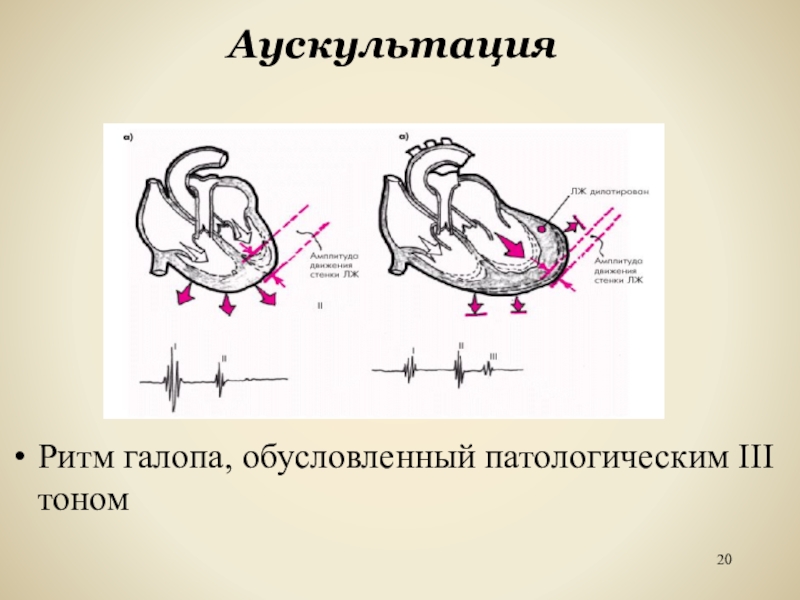 Схема ритма галопа