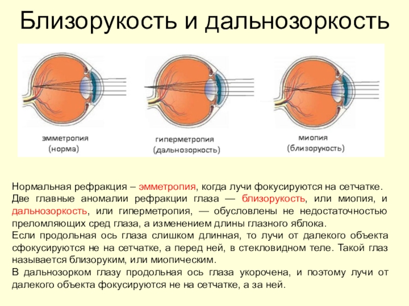 Перед сетчаткой расположена. Аномалии рефракции глаза астигматизм. Миопия миопия гиперметропия. Эмметропия миопия гиперметропия астигматизм. Схема распространения лучей в близоруком глазу.
