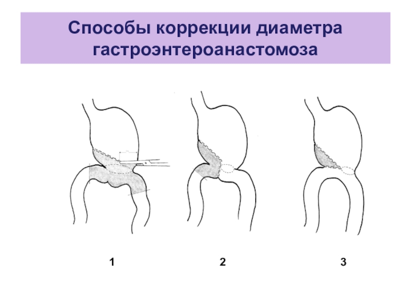 Болезни оперированного желудка презентация