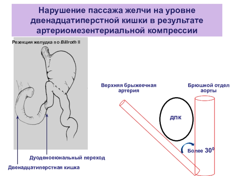 По Billroth II.. Патофизиология оперированного желудка.