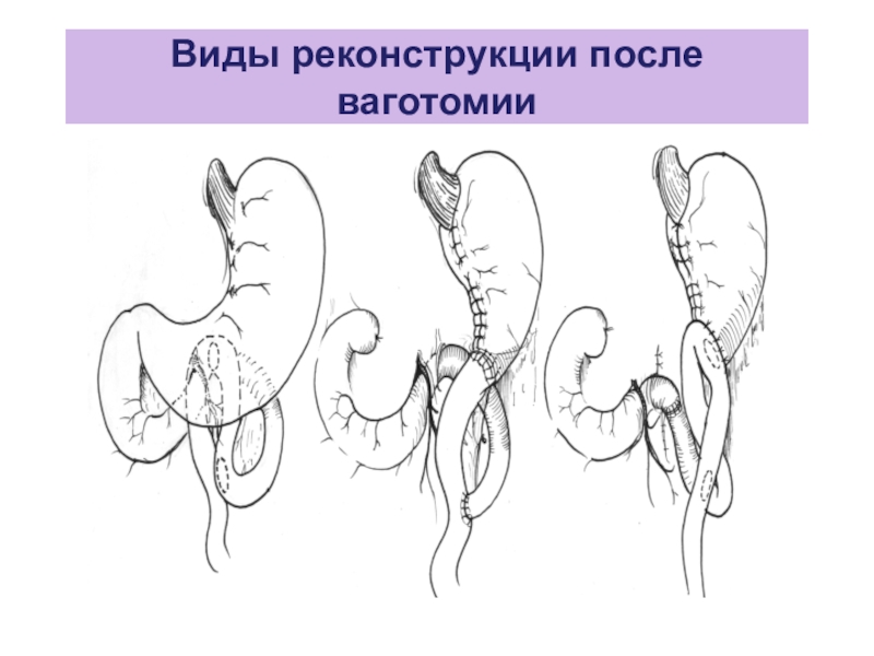 Болезни оперированного желудка презентация